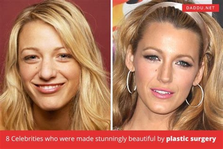 Diane Kruger Plastic Surgery Before and After