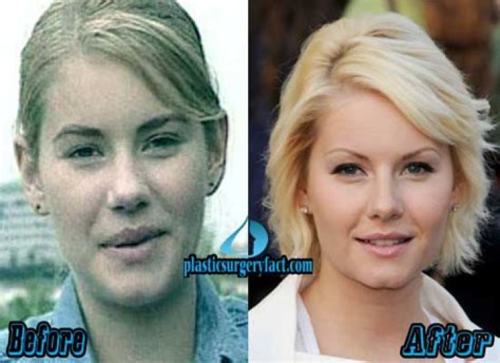 Elisha Cuthbert Plastic Surgery Before and After