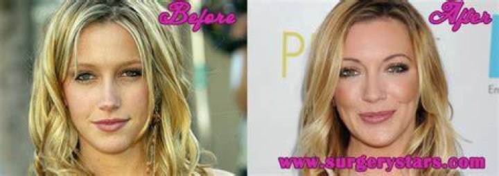 Katie Cassidy Plastic Surgery Before and After
