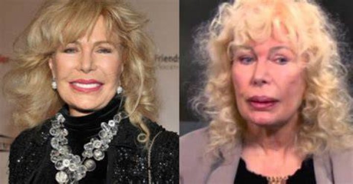 loretta swit plastic surgery