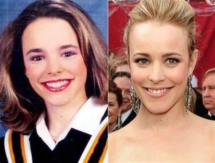 Rachel McAdams Plastic Surgery Before and After