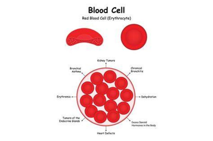 Red Blood Cell Alterations Contribute to Lupus