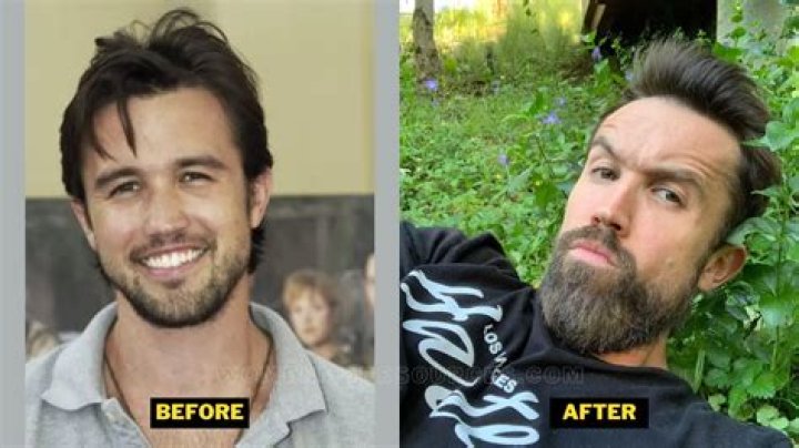 rob mcelhenney plastic surgery