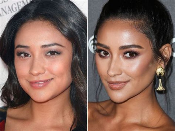 Shay Mitchell Plastic Surgery Before and After