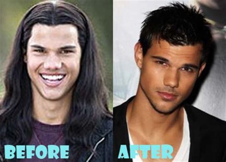 Taylor Lautner Plastic Surgery Before and After