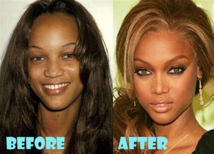 Tyra Banks Plastic Surgery Before and After